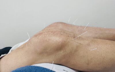 🌿 Inflamación tras una prótesis de rodilla: ¿cómo puede ayudar la acupuntura?